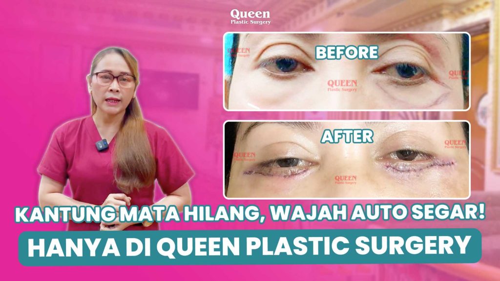 Bye Kantung Mata! Kenali Prosedur Transfer Lemak di Bawah Mata untuk Mengembalikan Kesegaran Wajah