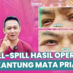 Tampil Lebih Segar! Mengenal Prosedur Peremajaan Kelopak Mata yang Ideal untuk Pria