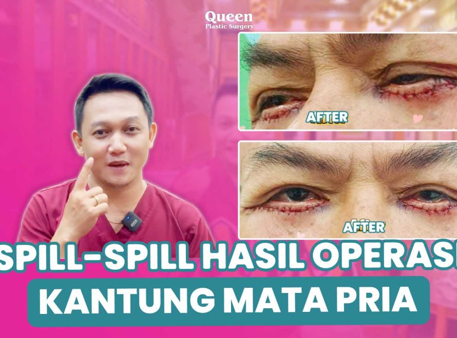 Tampil Lebih Segar! Mengenal Prosedur Peremajaan Kelopak Mata yang Ideal untuk Pria
