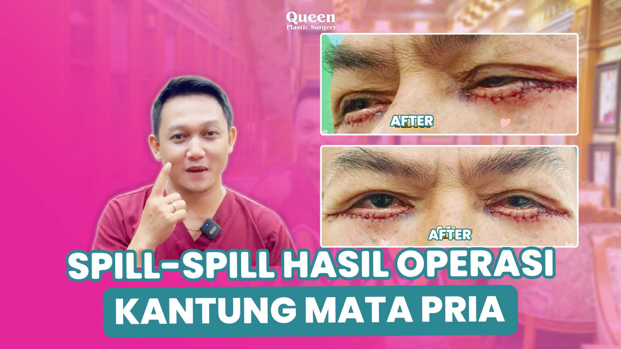 Tampil Lebih Segar! Mengenal Prosedur Peremajaan Kelopak Mata yang Ideal untuk Pria