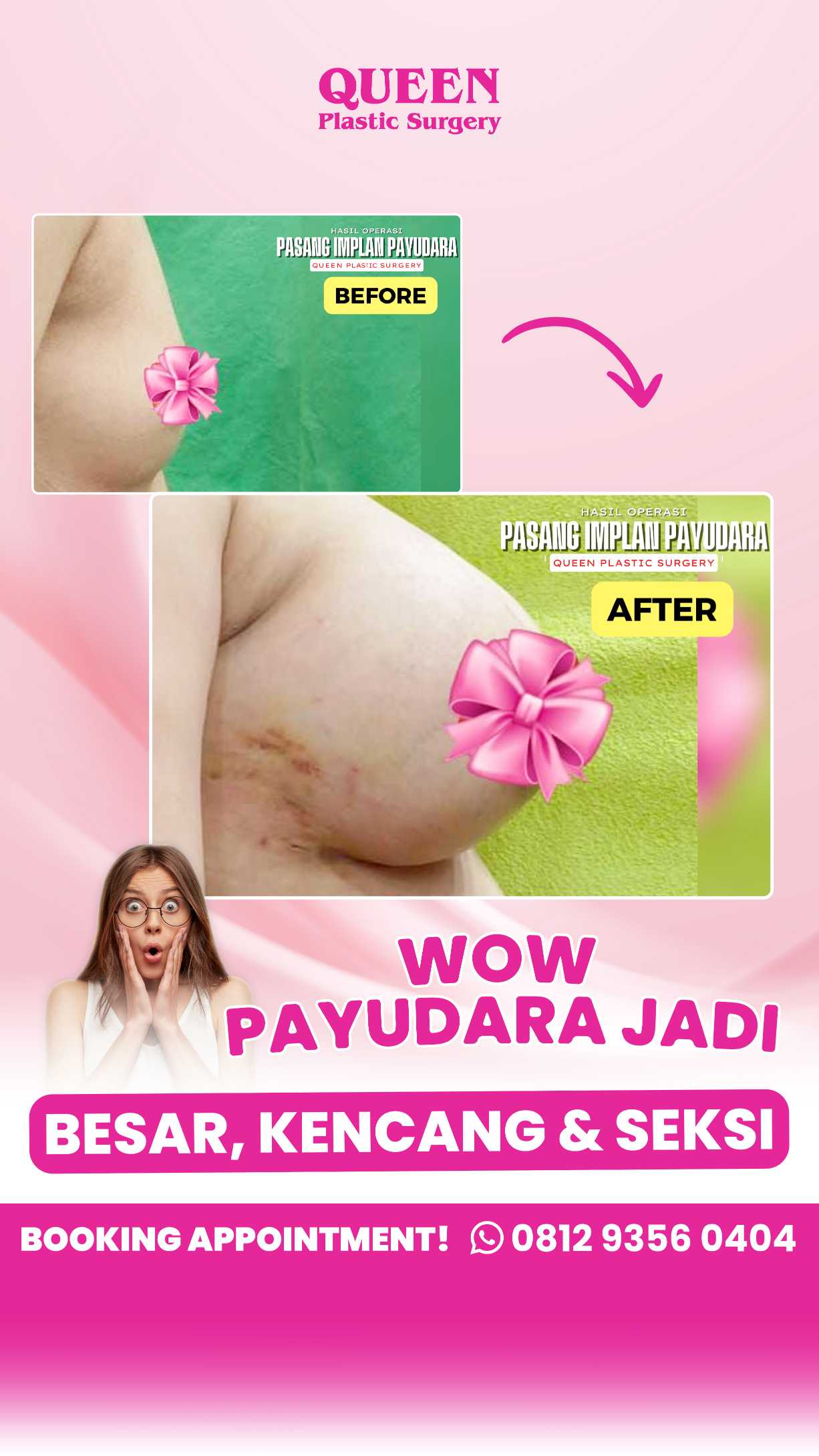 Penempatan Implan Payudara: Mengupas Tuntas Pilihan di Atas Otot vs. di Bawah Otot