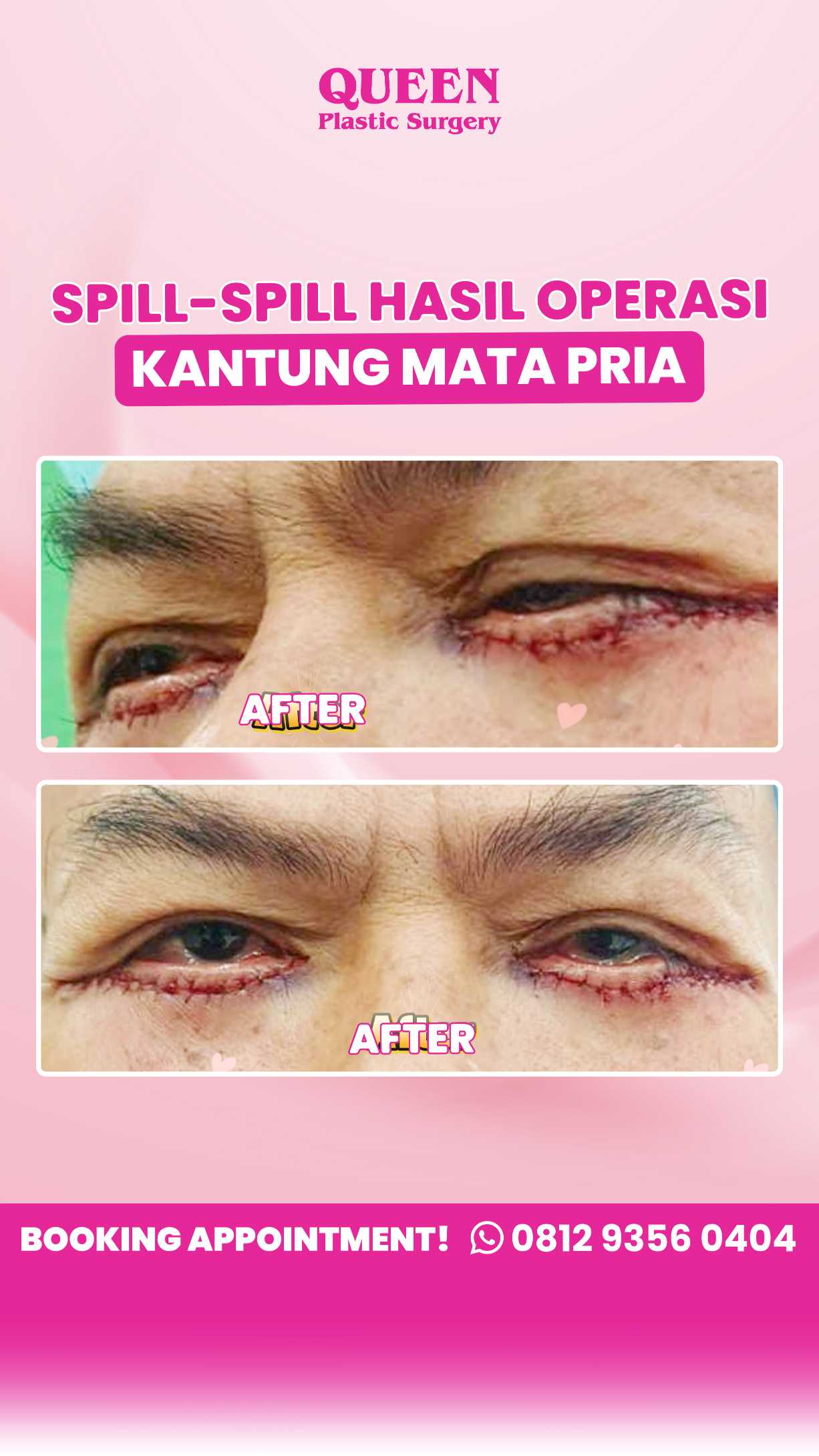 Tampil Lebih Segar! Mengenal Prosedur Peremajaan Kelopak Mata yang Ideal untuk Pria