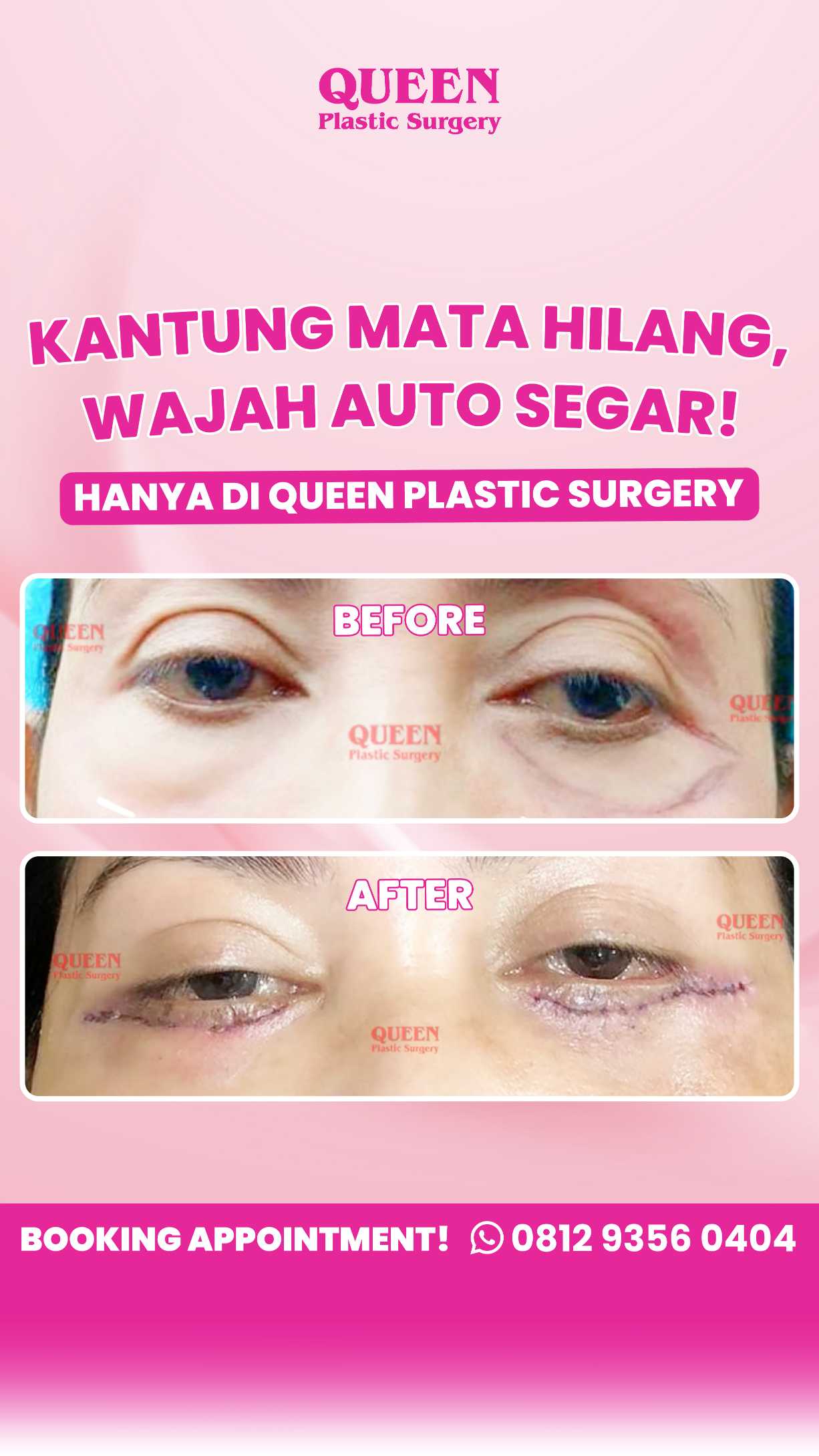 Kantung Mata Mengganggu? Ini Pilihan Perawatan Terbaik, dari Non-Invasif hingga Medis