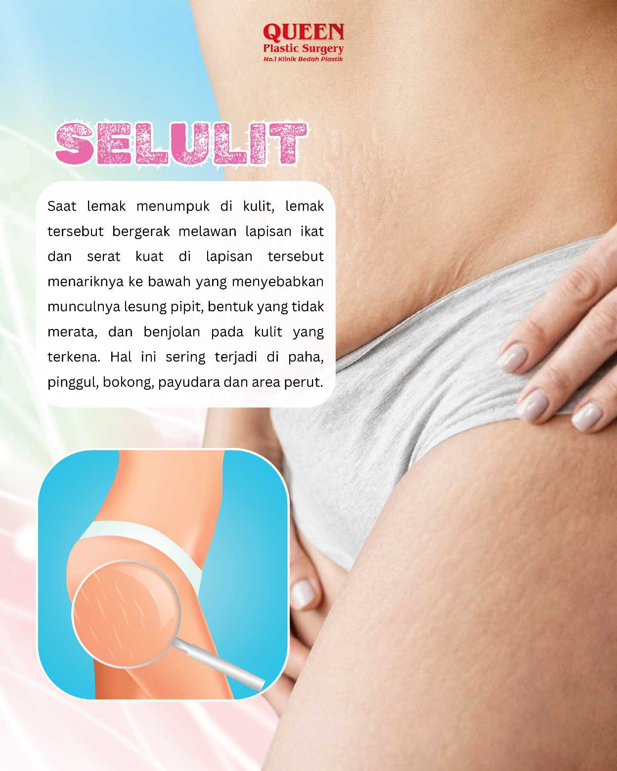 Bye-Bye Mitos: Ini Dia Fakta Sebenarnya Seputar Selulit