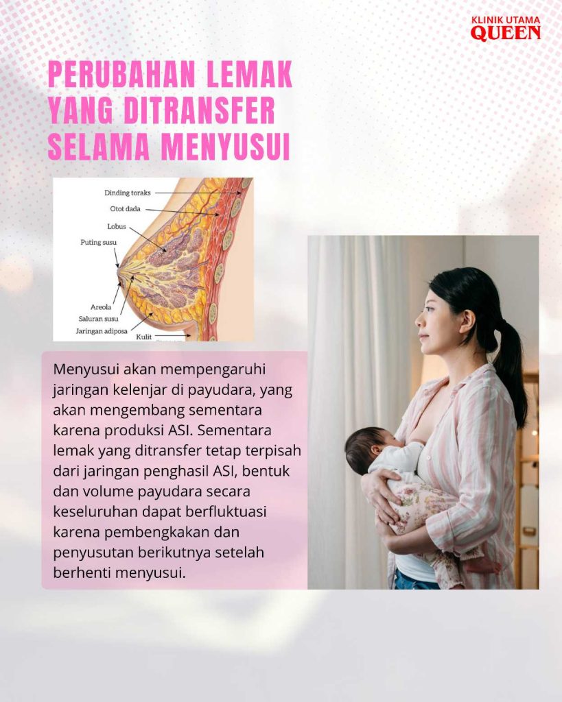 Amankah Pembesaran Payudara Dengan Transfer Lemak Saat Kehamilan dan Menyusui? Ini Fakta yang Perlu Diketahui