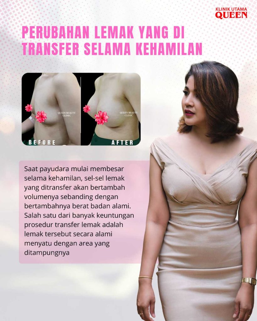 Amankah Pembesaran Payudara Dengan Transfer Lemak Saat Kehamilan dan Menyusui? Ini Fakta yang Perlu Diketahui