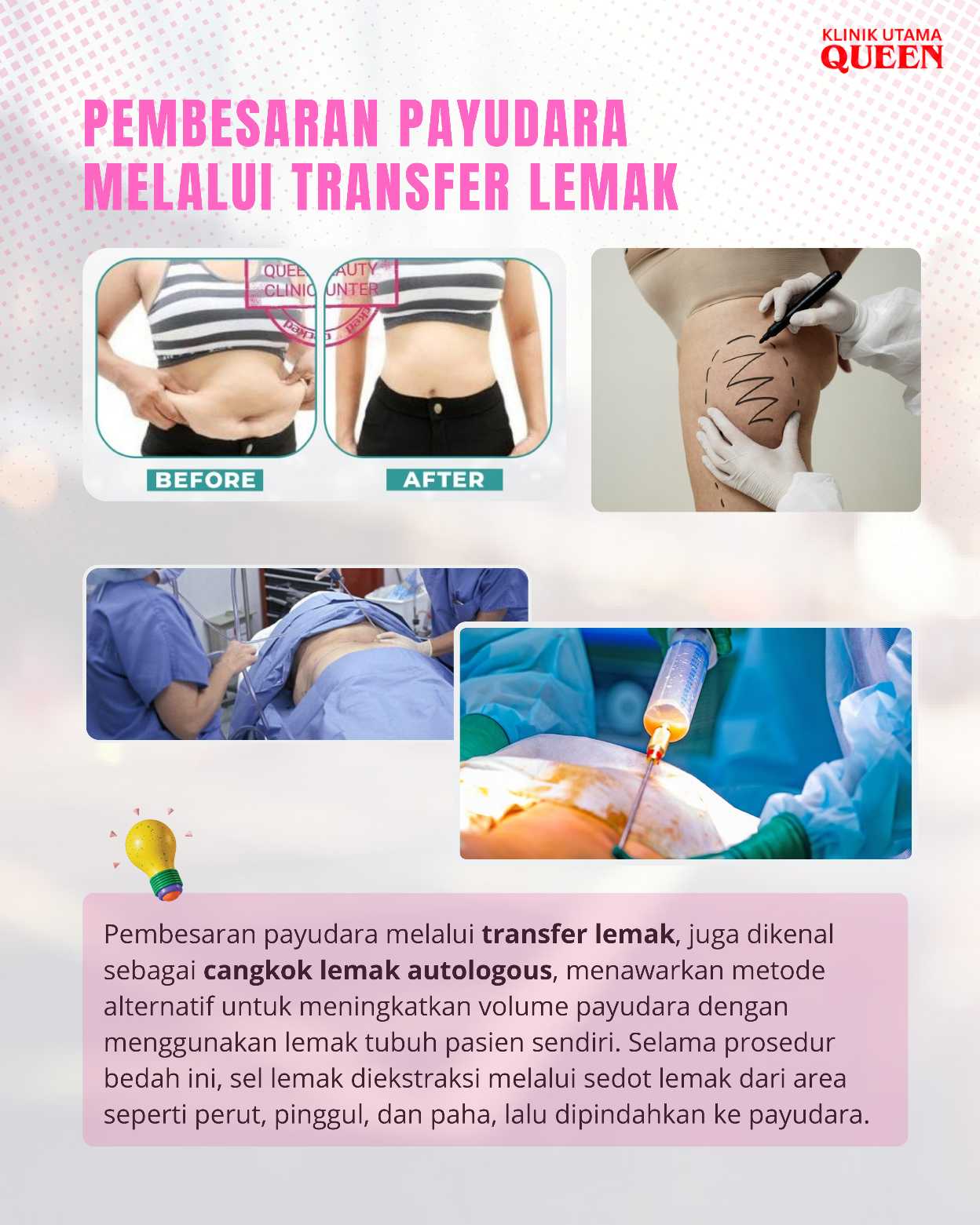 Bagaimana Hasil Pembesaran Payudara Melalui Transfer Lemak Bertahan Setelah 5 Tahun?