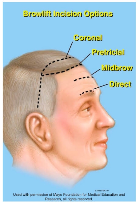 Mengupas Tuntas Perbedaan Temple Lift dan Brow Lift: Kenali Prosedur & Hasilnya!