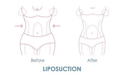Berapa Banyak Lemak Hilang Setelah Liposuction? Temukan Batasnya! 
