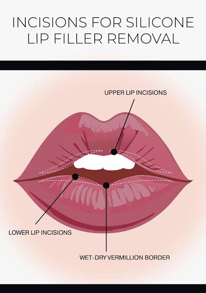 Suntikan Silikon Bikin Bibir Rusak? Ini Solusi Koreksi untuk Mengembalikan Estetika Bibir Anda