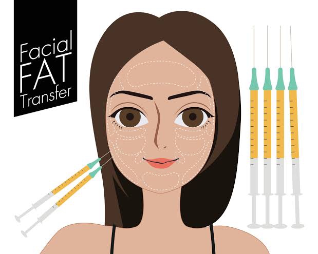 Dari Mengisi Cekungan hingga Mengurangi Garis Halus. Ini Dia Manfaat Transfer Lemak Wajah!