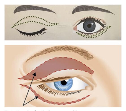 Jangan Percaya Mitos! Pahami Waktu Pemulihan Blepharoplasty yang Realistis di Sini