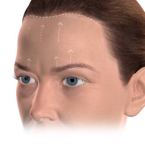 Brow Lift vs Blepharoplasty: Mana yang Lebih Cocok untuk Mengatasi Kelopak Mata Kendur?