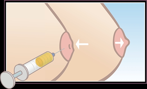 Dermal Filler untuk Puting: Alternatif Cepat untuk Koreksi Proyeksi dan Bentuk