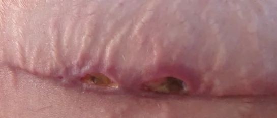 Jangan Panik! Mengatasi Nekrosis Lemak yang Terjadi Setelah Operasi Tummy Tuck