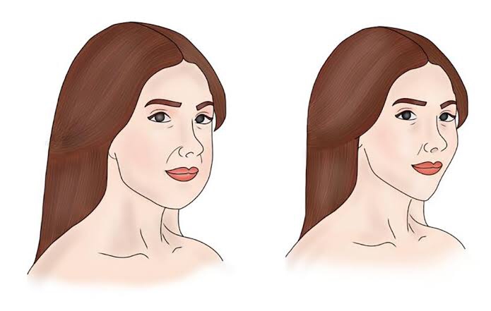 Mitos Pengangkatan Lemak Pipi Bikin Cepat Tua? Ini Fakta Ilmiahnya!