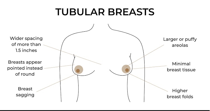 Penyebab Payudara Tuberous (Tubular Breast) dan Solusi Bedah Plastik untuk Mengoreksinya