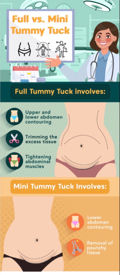Full Tummy Tuck vs. Mini Tummy Tuck, Mana yang Lebih Cocok untuk Anda? Simak Perbandingannya!