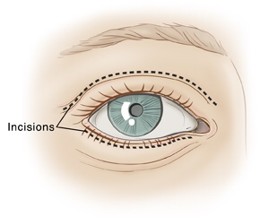 Bukan Sembarang Orang! Kenali Persyaratan Medis untuk Bisa Menjalani Blepharoplasty