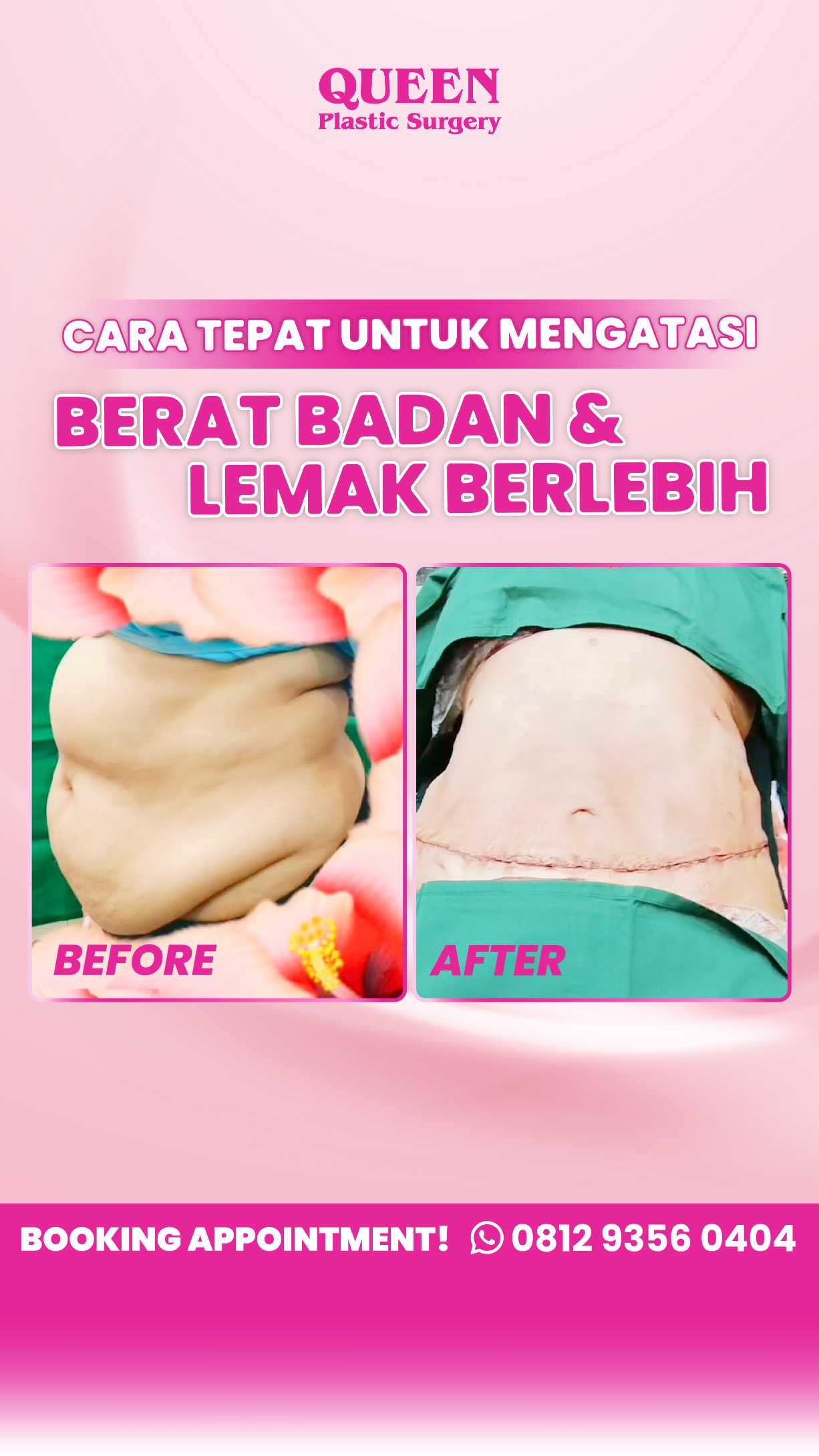 Akankah Kulit Menjadi Kencang Setelah Sedot Lemak? Ini Penjelasan Lengkapnya!