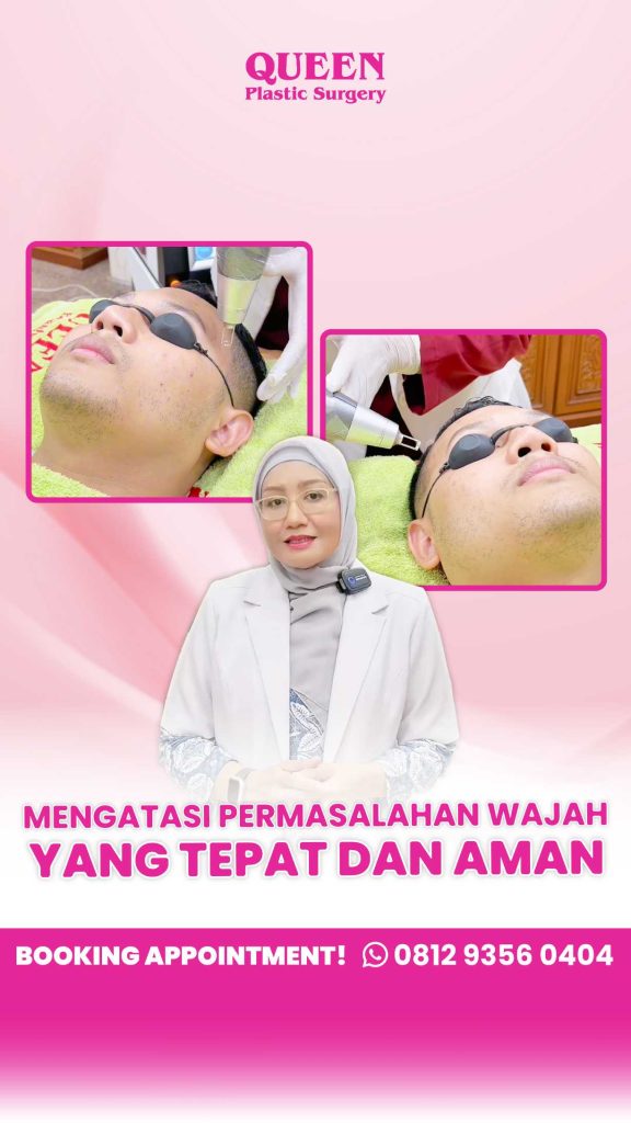 Mata Sayu Kembali Segar dengan Operasi Pengencangan Sub Alis (Sub-Brow Lift)