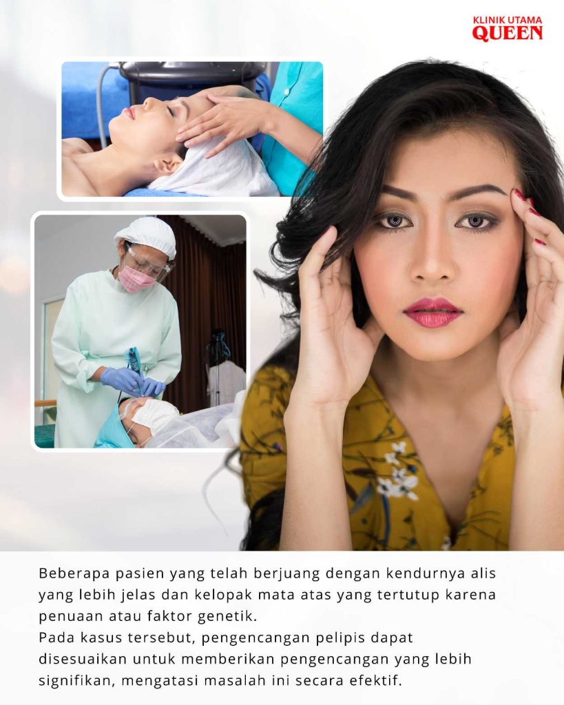 Ini Dia Alasan Kuat Mengapa Anda Perlu Pertimbangkan Operasi Pengencangan Pelipis (Forehead Lift)