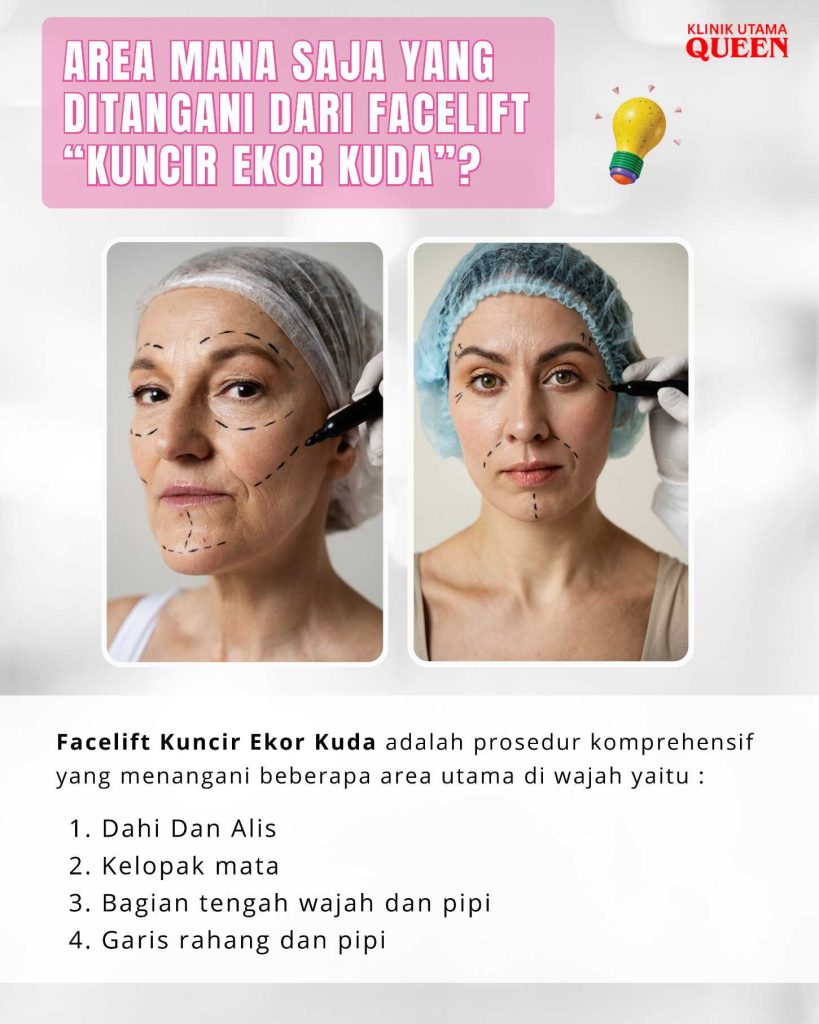 Facelift "Kuncir Ekor Kuda": Rahasia Wajah Kencang dan Tirus Tanpa Bekas Luka Terlihat