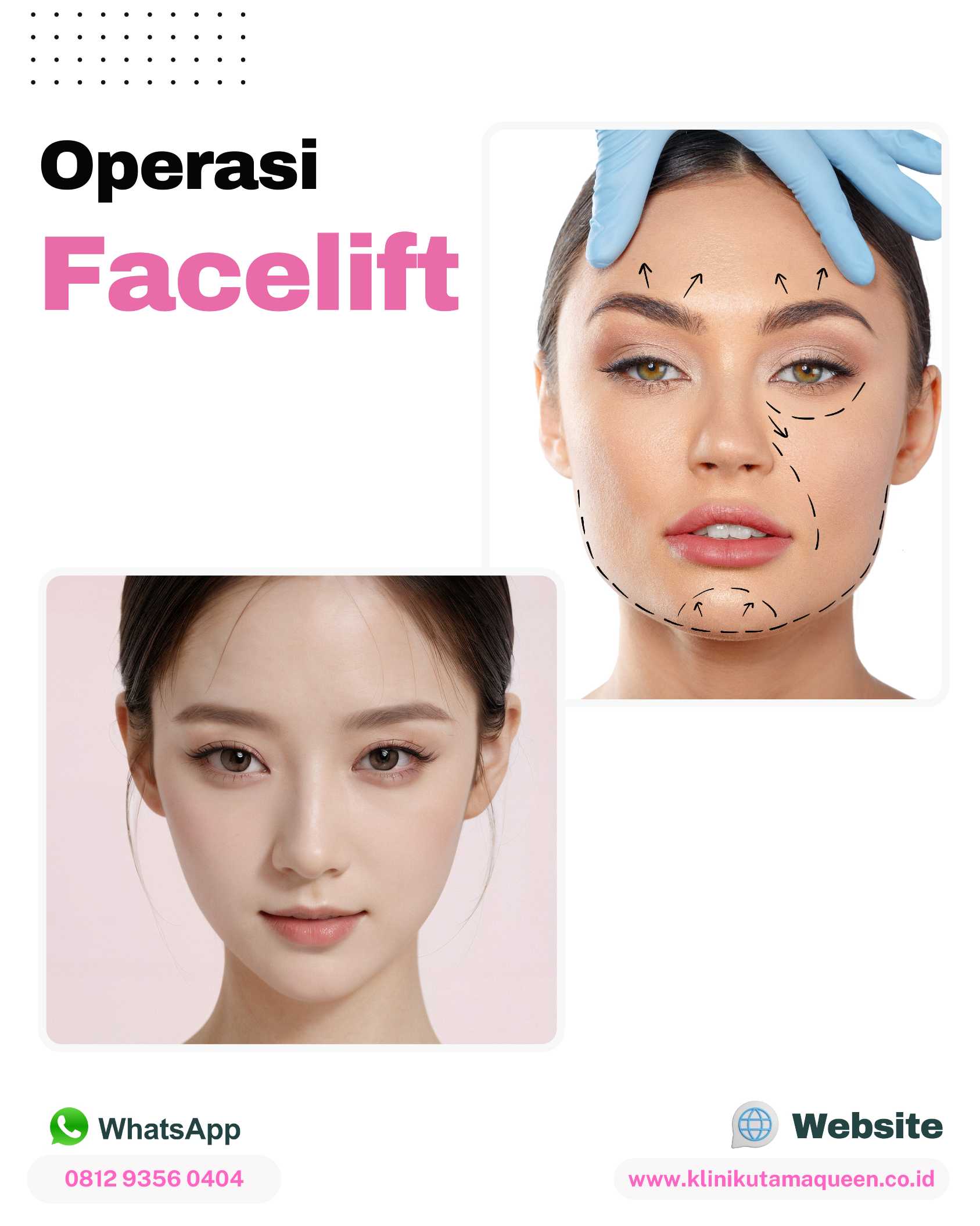 Hasil Maksimal! Keuntungan Menjalani Operasi Facelift dan Neck Lift Secara Bersamaan