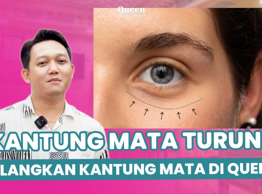 Kantung Mata Mengganggu? Ini Pilihan Perawatan Terbaik, dari Non-Invasif hingga Medis
