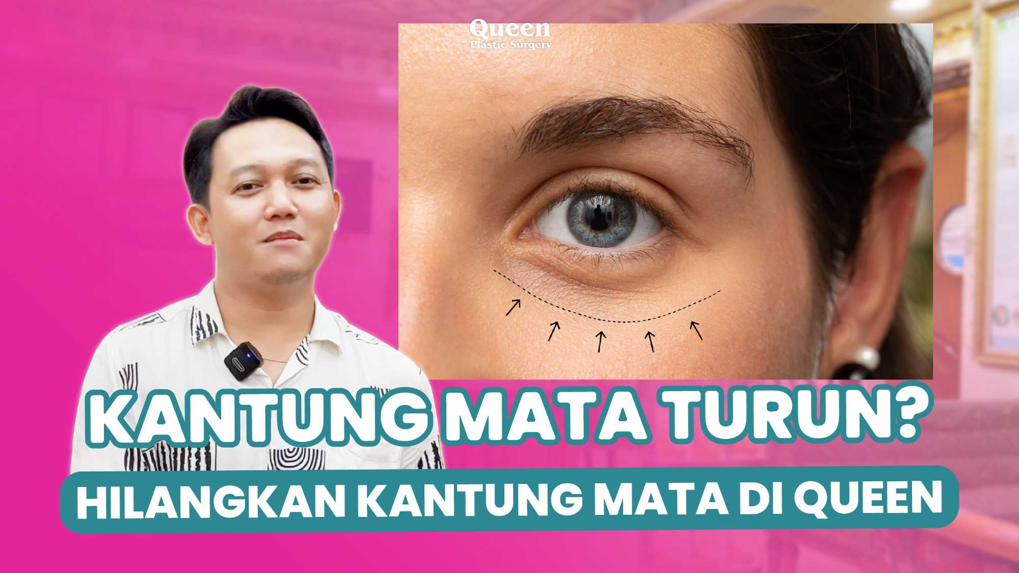 Transfer Lemak Bawah Mata: Kelebihan dan Kekurangan yang Perlu Anda Tahu