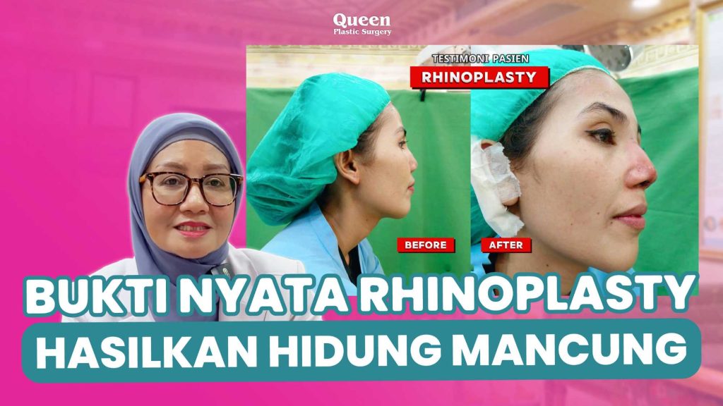 Berapa Lama Operasi Hidung Dapat Bertahan? Cari Tahu Faktanya!