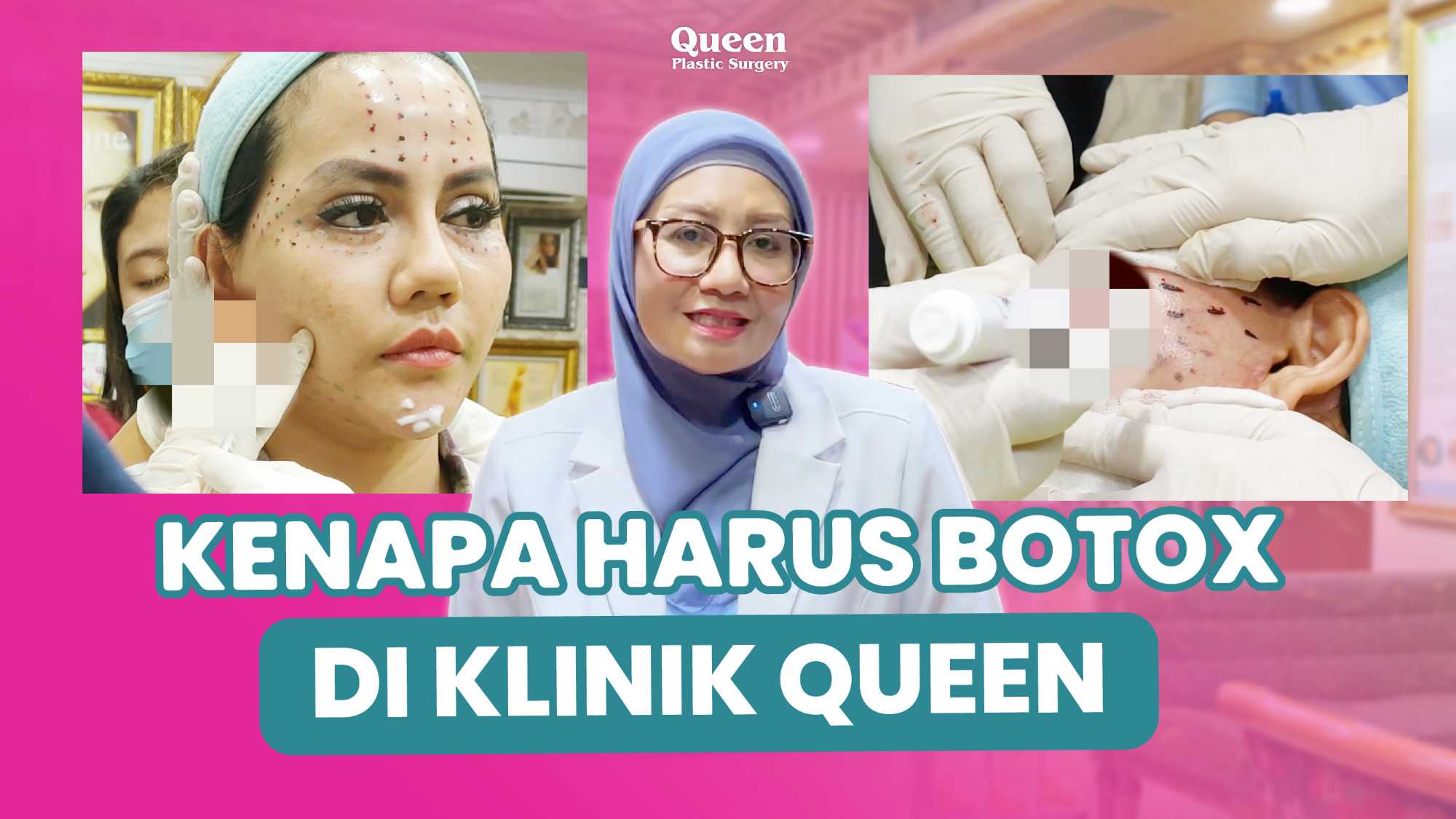 Bukan Hanya Filler, Botox Juga Bisa Bikin Hidung Lebih Ramping!