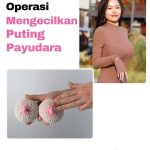 Penyebab Payudara Tuberous (Tubular Breast) dan Solusi Bedah Plastik untuk Mengoreksinya