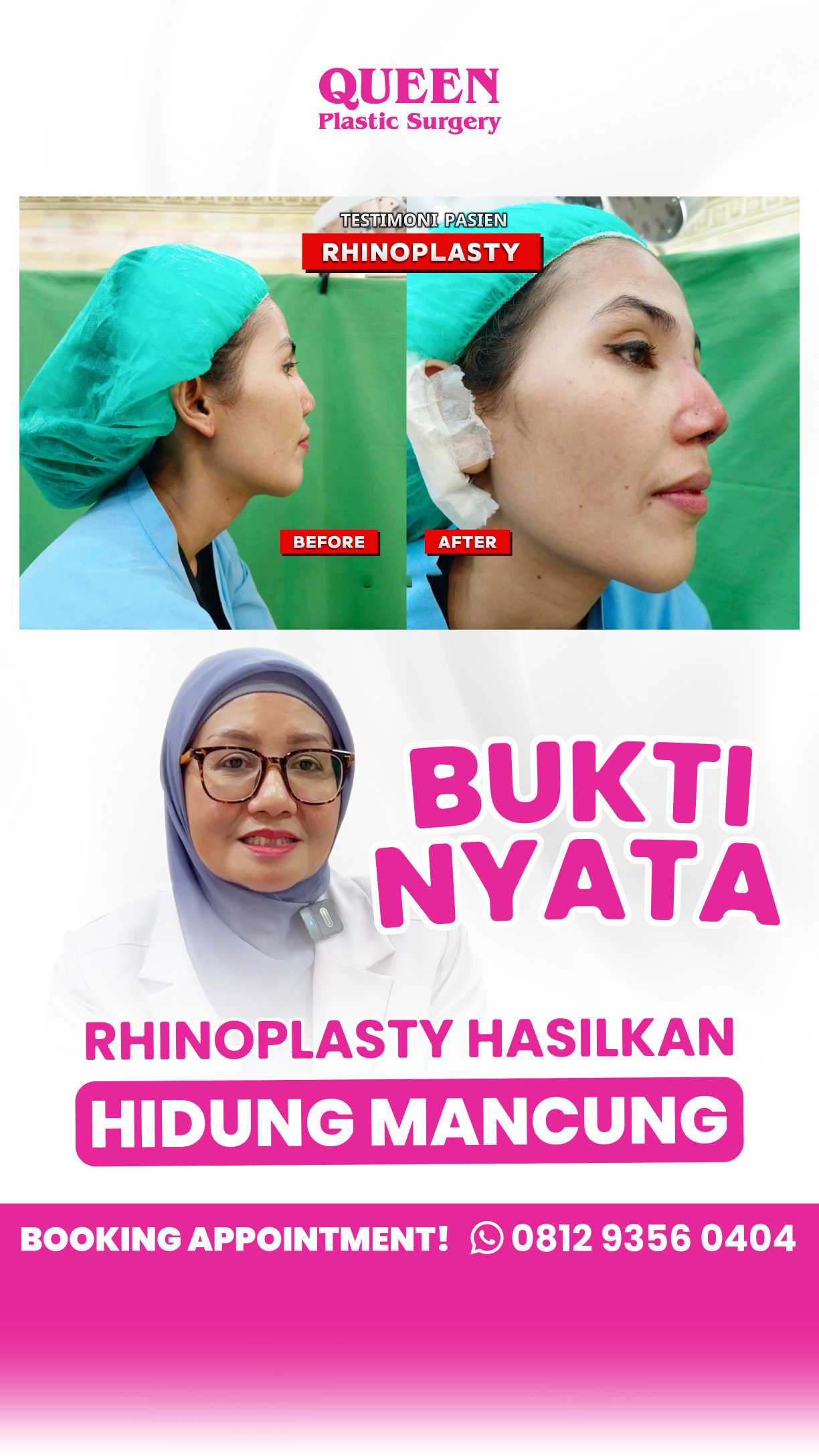 Berapa Lama Operasi Hidung Dapat Bertahan? Cari Tahu Faktanya!