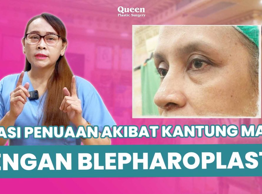 Operasi Kelopak Mata Bawah Cara Ampuh Atasi Kerutan Membandel