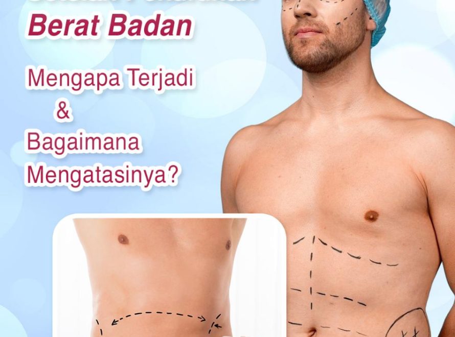 Ginekomastia Setelah Penurunan Berat Badan: Mengapa Terjadi dan Bagaimana Mengatasinya?