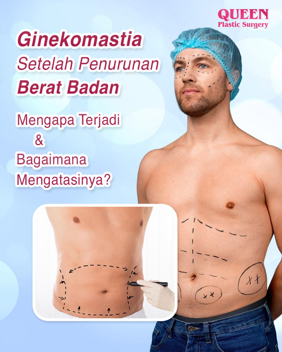 Ginekomastia Setelah Penurunan Berat Badan: Mengapa Terjadi dan Bagaimana Mengatasinya?