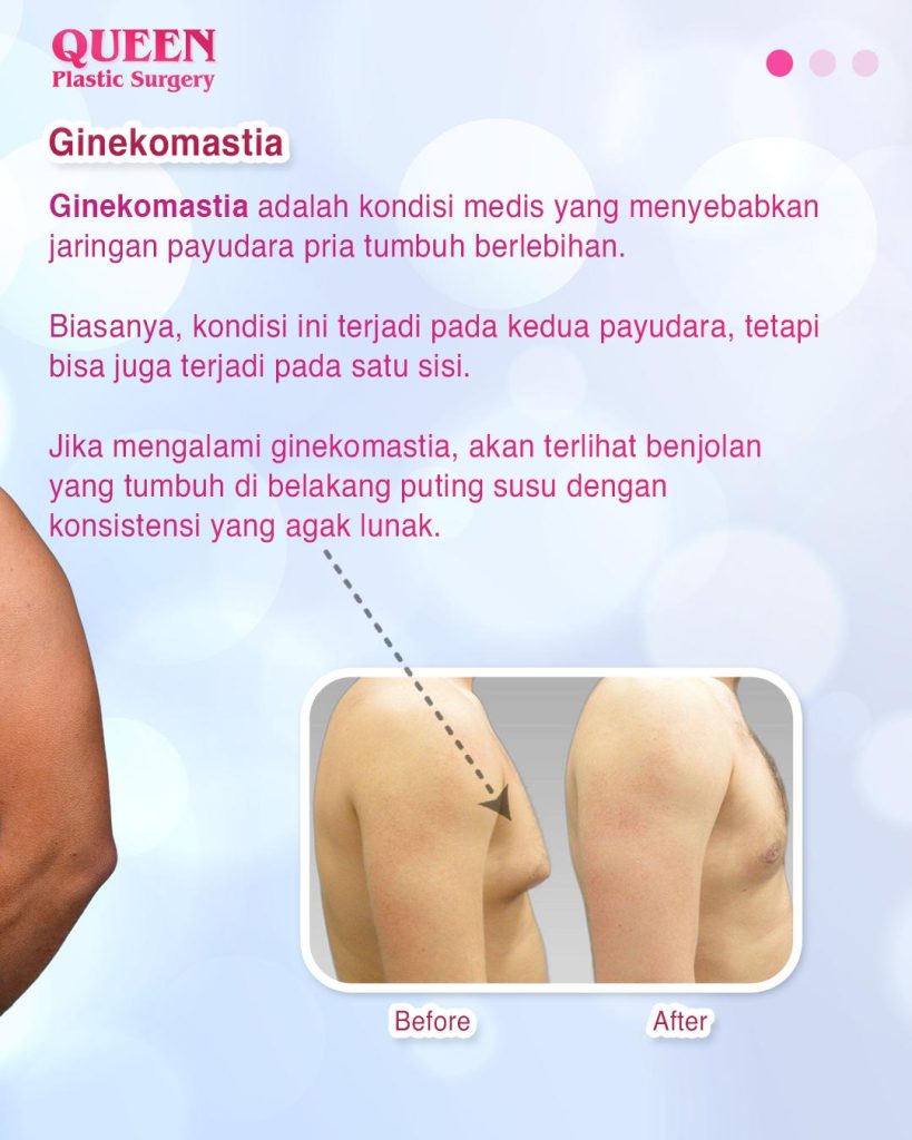 Ginekomastia Setelah Penurunan Berat Badan: Mengapa Terjadi dan Bagaimana Mengatasinya?