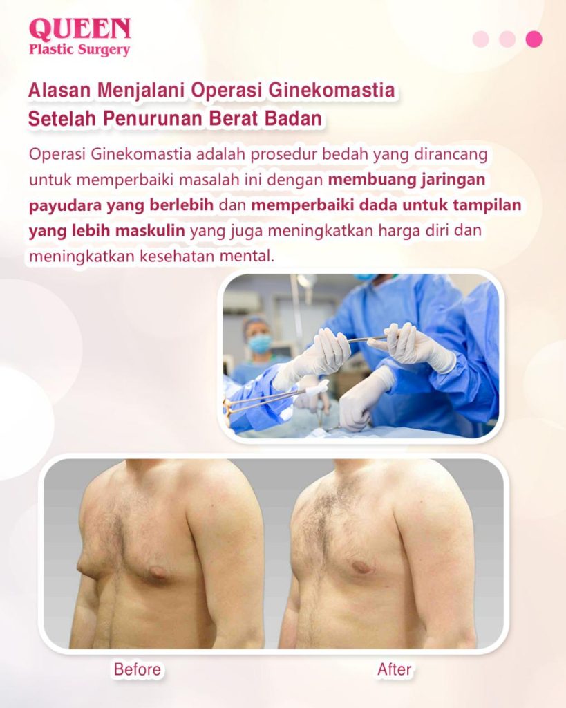 Ginekomastia Setelah Penurunan Berat Badan: Mengapa Terjadi dan Bagaimana Mengatasinya?