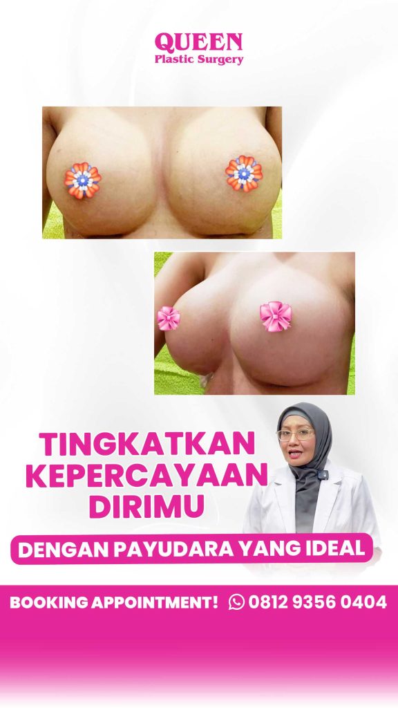 Implan Payudara Bergeser? Kenali Penyebab & Solusi Yang Tepat!