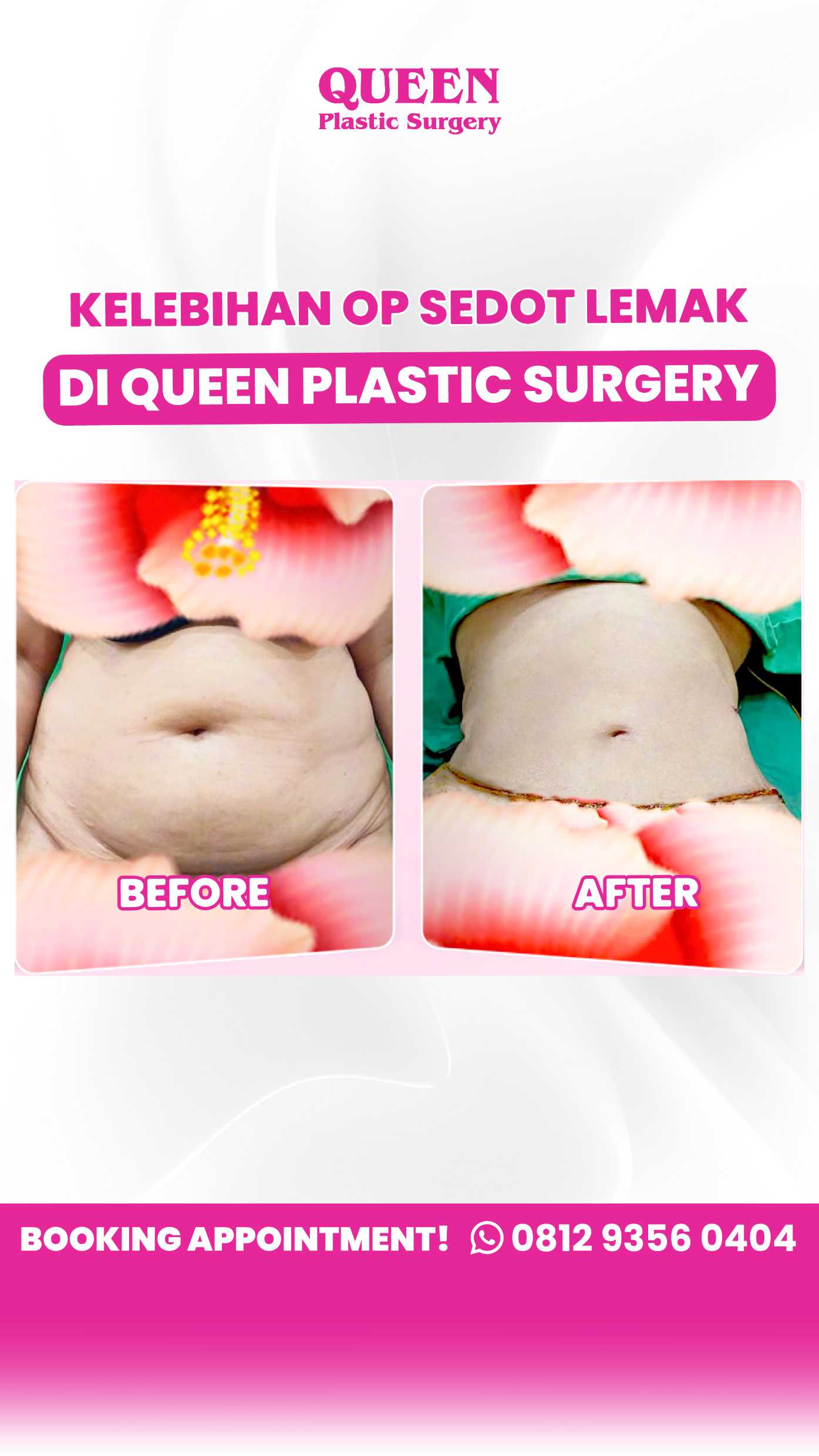 Berapa Banyak Lemak Hilang Setelah Liposuction? Temukan Batasnya!