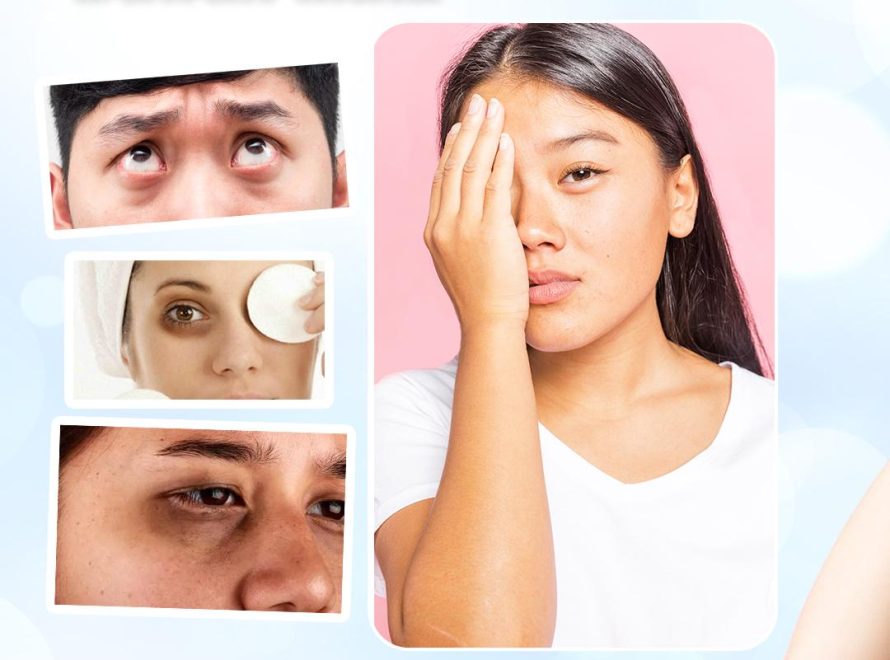 Transfer Lemak Bawah Mata: Kelebihan dan Kekurangan yang Perlu Anda Tahu