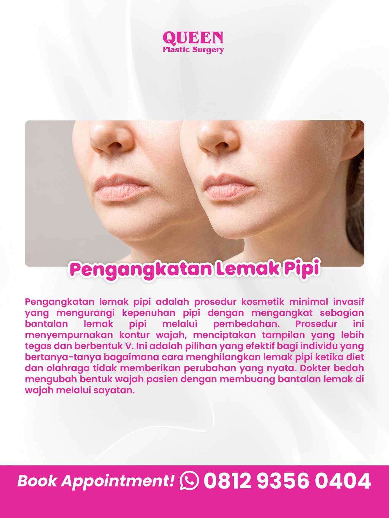 Bye-Bye Pipi Chubby! Merampingkan Wajah Bulat dengan Operasi Pengangkatan Lemak Pipi