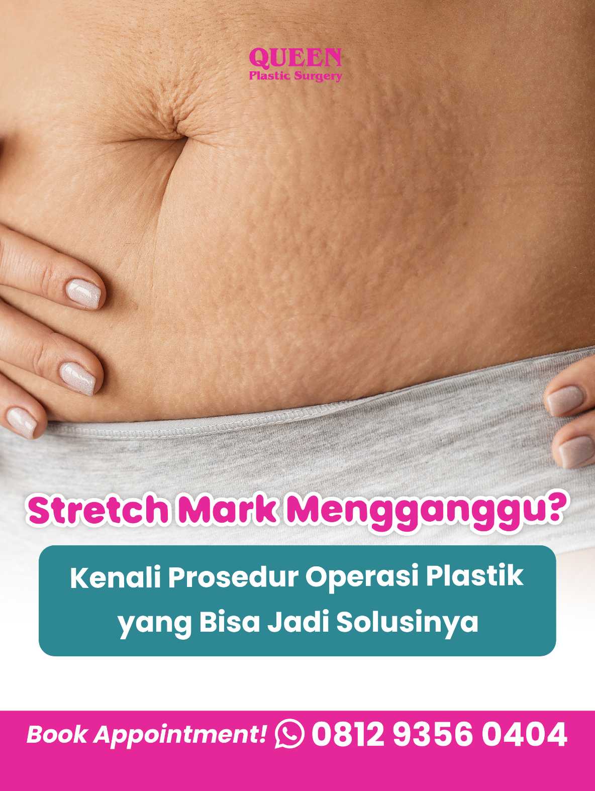 Stretch Mark Mengganggu? Kenali Prosedur Operasi Plastik yang Bisa Jadi Solusinya