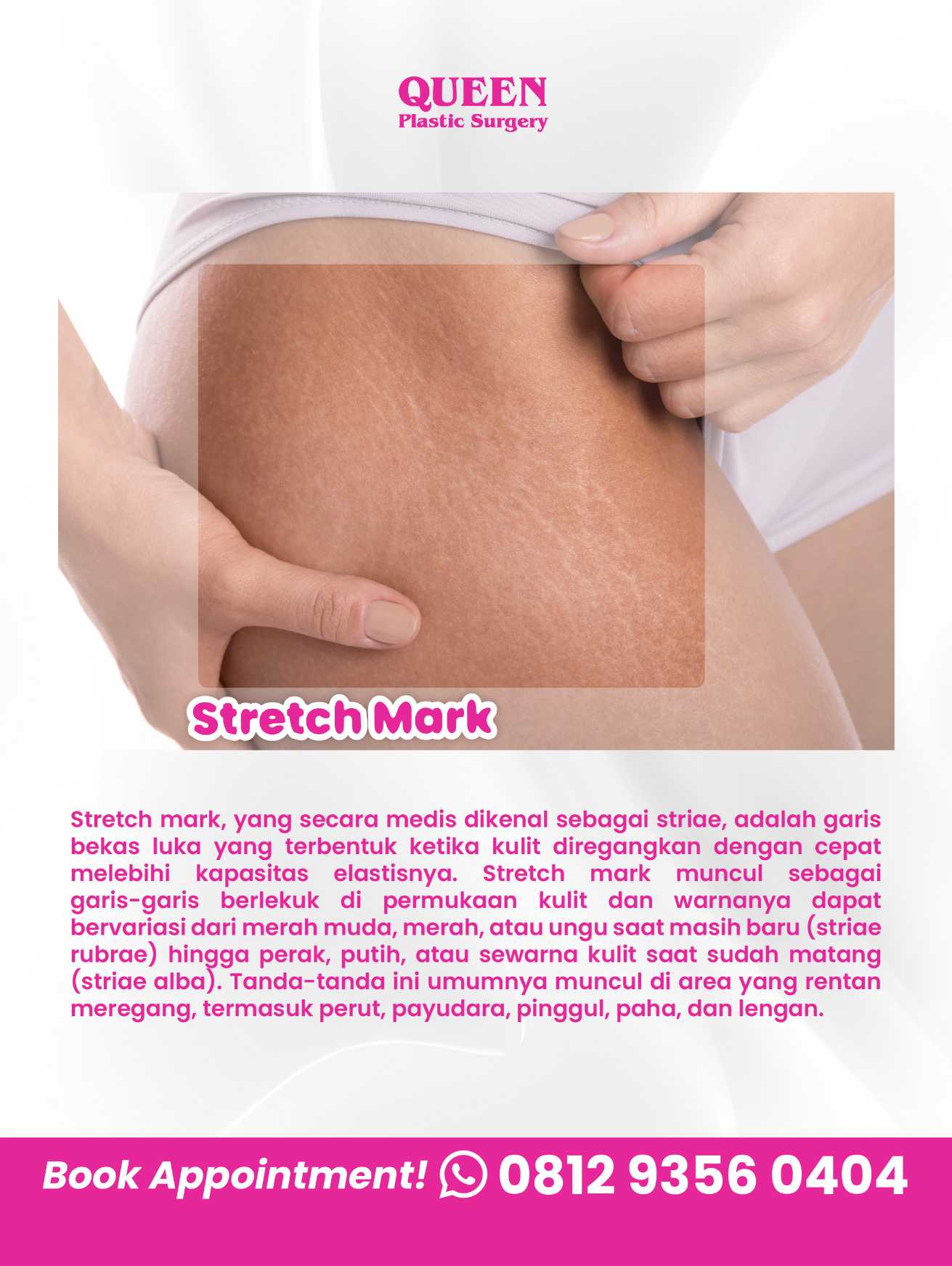 Stretch Mark Mengganggu? Kenali Prosedur Operasi Plastik yang Bisa Jadi Solusinya