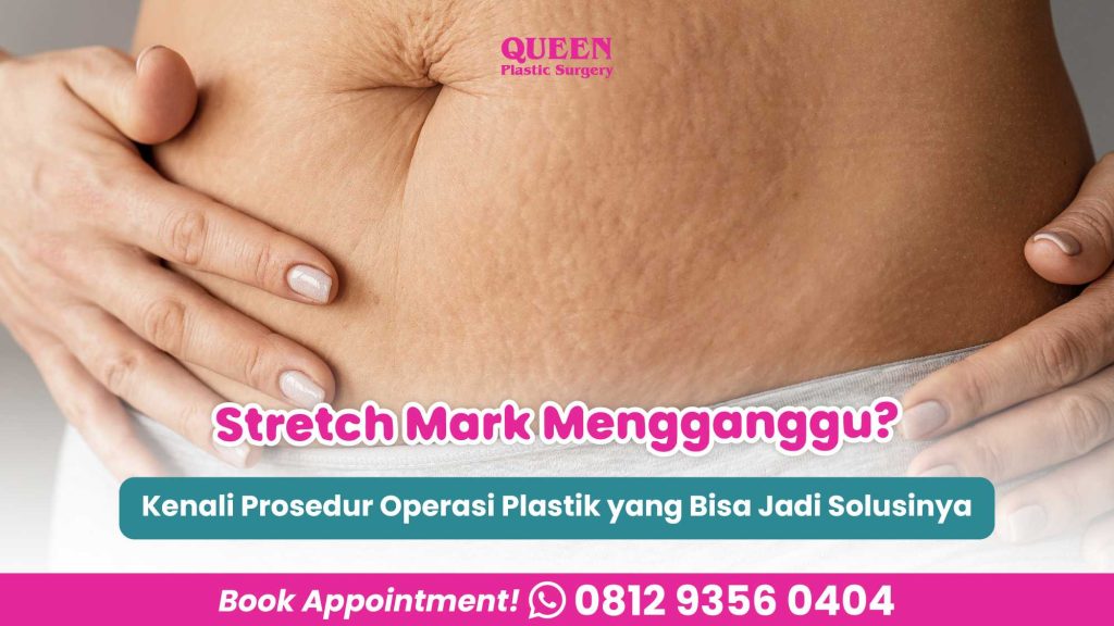 Stretch Mark Mengganggu? Kenali Prosedur Operasi Plastik yang Bisa Jadi Solusinya