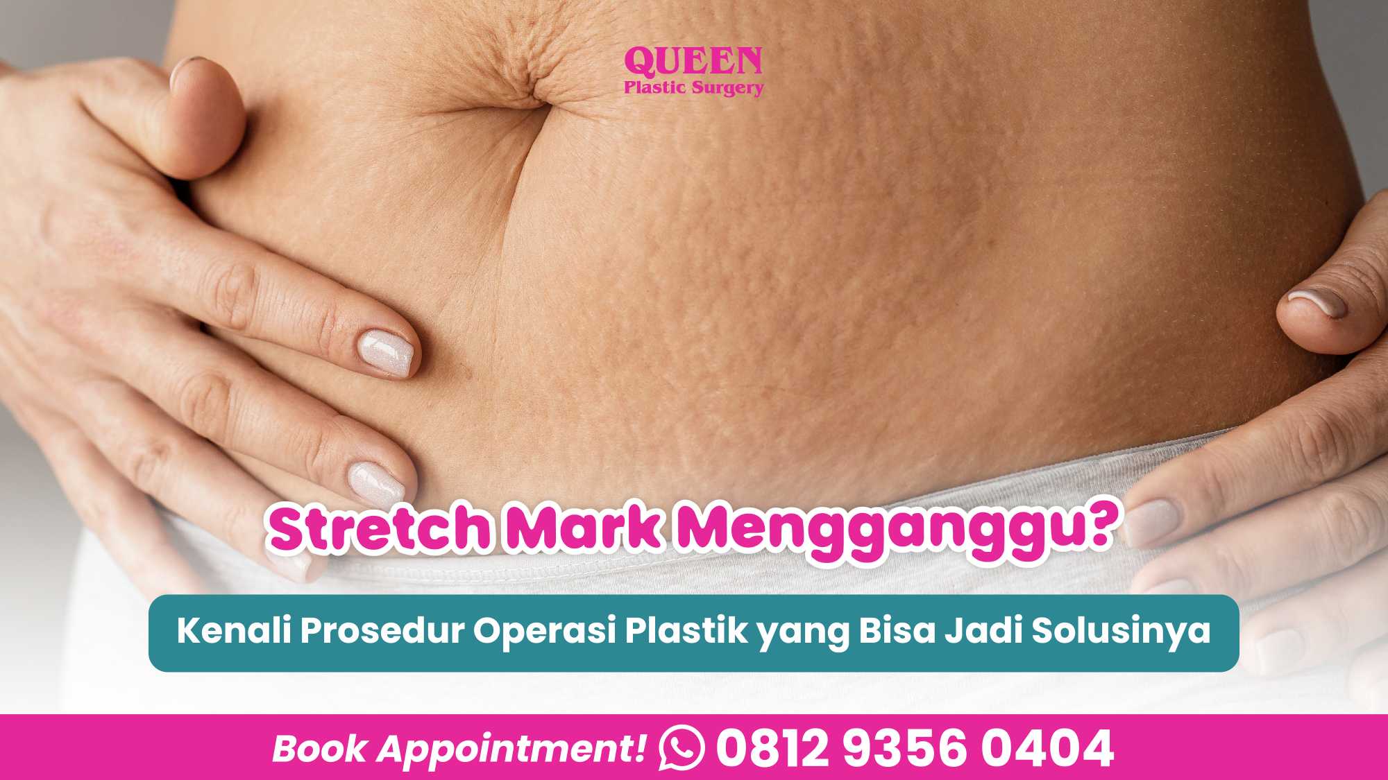 Stretch Mark Mengganggu? Kenali Prosedur Operasi Plastik yang Bisa Jadi Solusinya