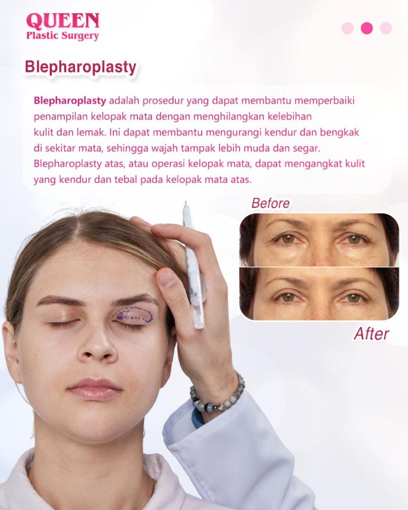 Brow Lift vs Blepharoplasty: Mana yang Lebih Cocok untuk Mengatasi Kelopak Mata Kendur?