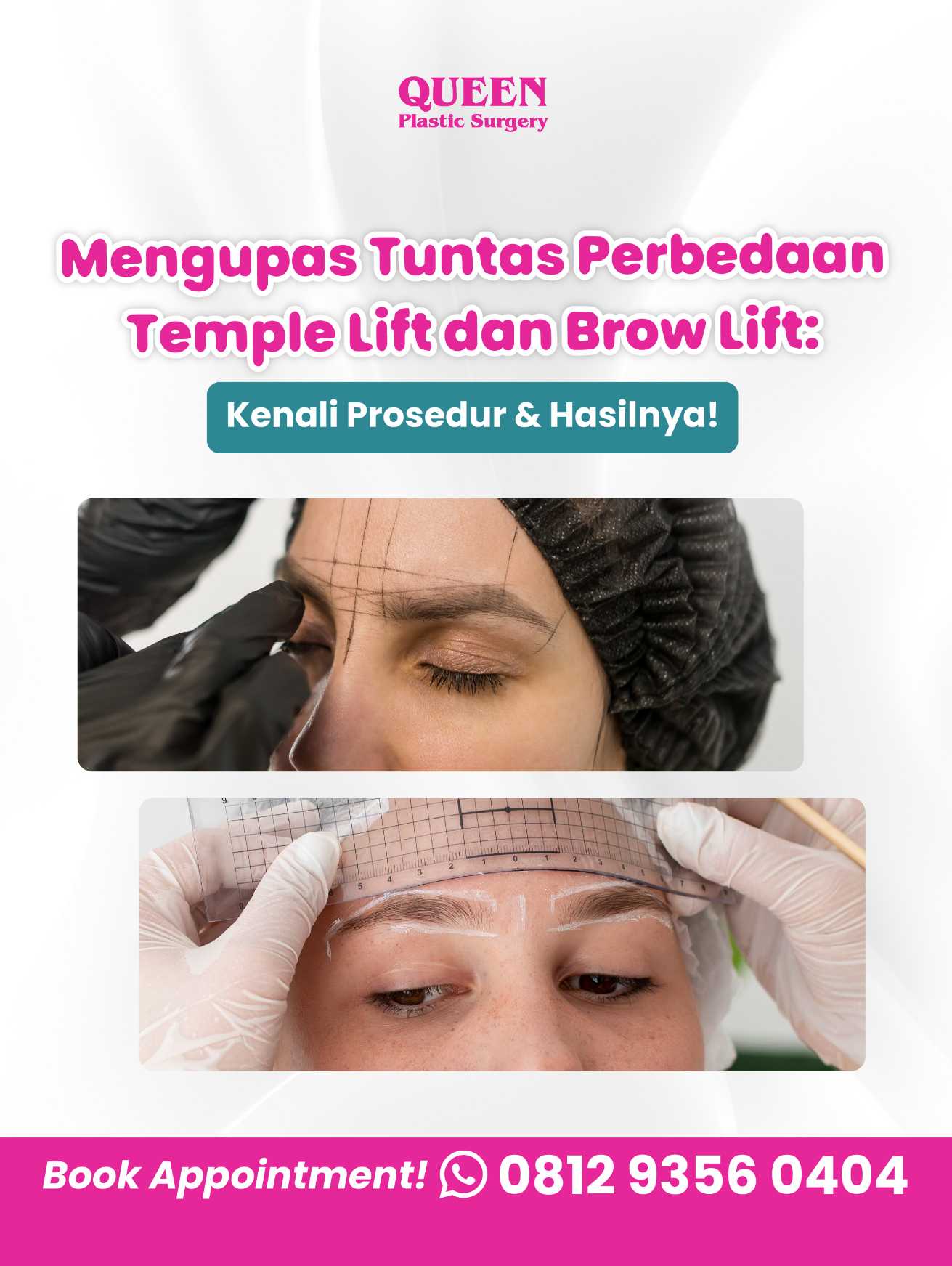 Mengupas Tuntas Perbedaan Temple Lift dan Brow Lift: Kenali Prosedur & Hasilnya!
