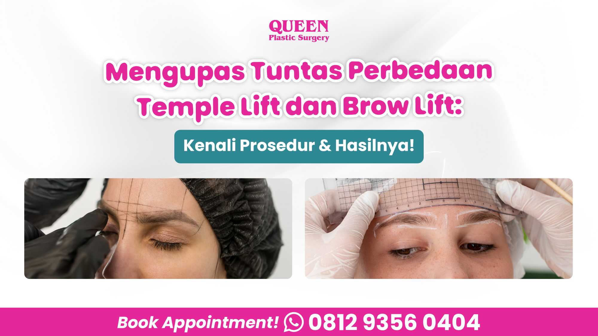 Mengupas Tuntas Perbedaan Temple Lift dan Brow Lift: Kenali Prosedur & Hasilnya!